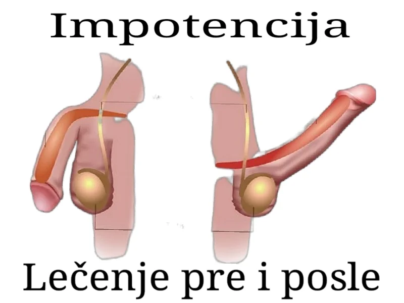 Impotencija lecenje